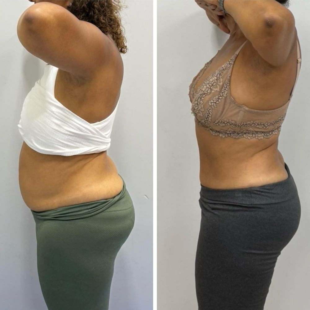 Antes e depois - resultado Afinatto
